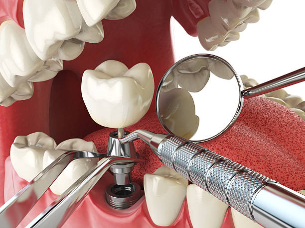 Best Emergency Dental Extractions in Clton, IN